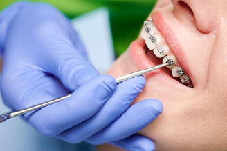 بهترین سن برای شروع ارتودنسی دندان