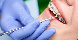 بهترین سن برای شروع ارتودنسی دندان