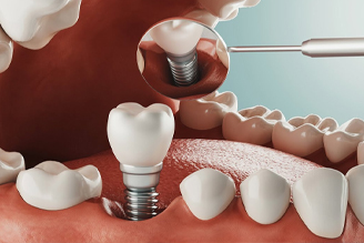صفر تا صد ایمپلنت دندان