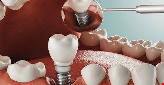 صفر تا صد ایمپلنت دندان